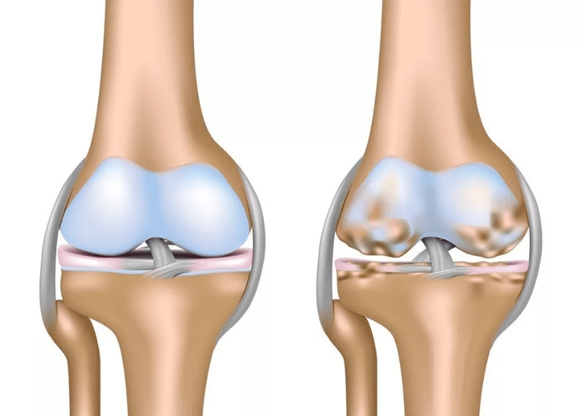 Arthrose