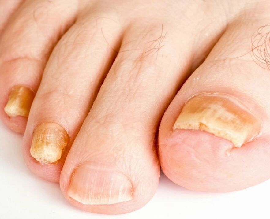 Nagelpilz