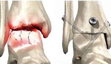 Chirurgische Behandlung von Knieosteoarthritis