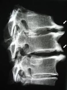 Osteophyten der Halswirbelsäule verursachen Nackenschmerzen.
