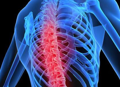 Osteochondrose der Brustwirbelsäule