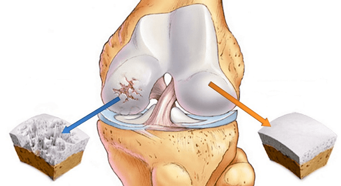 Gesunder Knorpel und von Arthrose betroffener Knorpel.