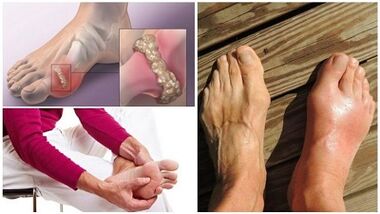 Was ist Arthritis der Gelenke