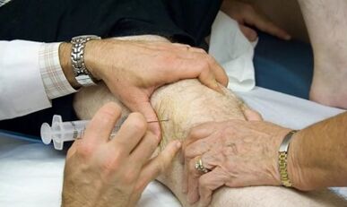 Wie man Arthrose Arthritis unterscheidet